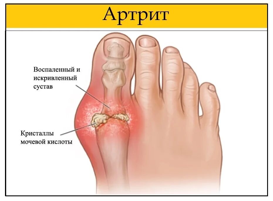 Болит основание сустава большого пальца. Подагра большого пальца стопы. Подагрический артрит большого пальца ноги.