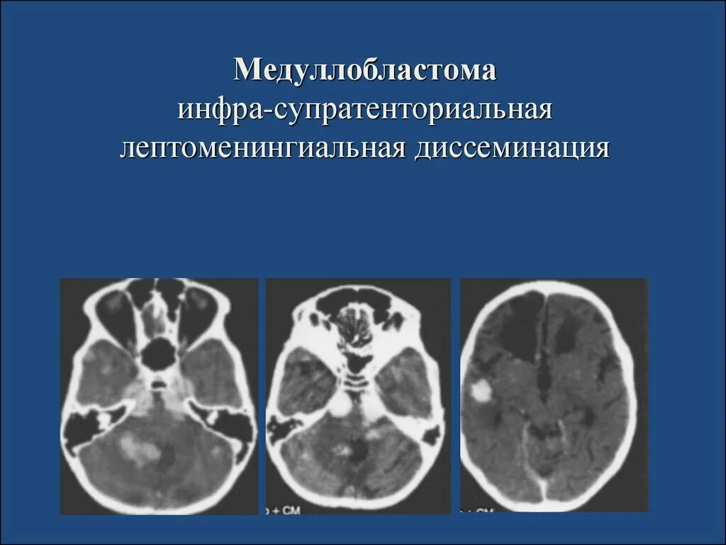 Медуллобластома это