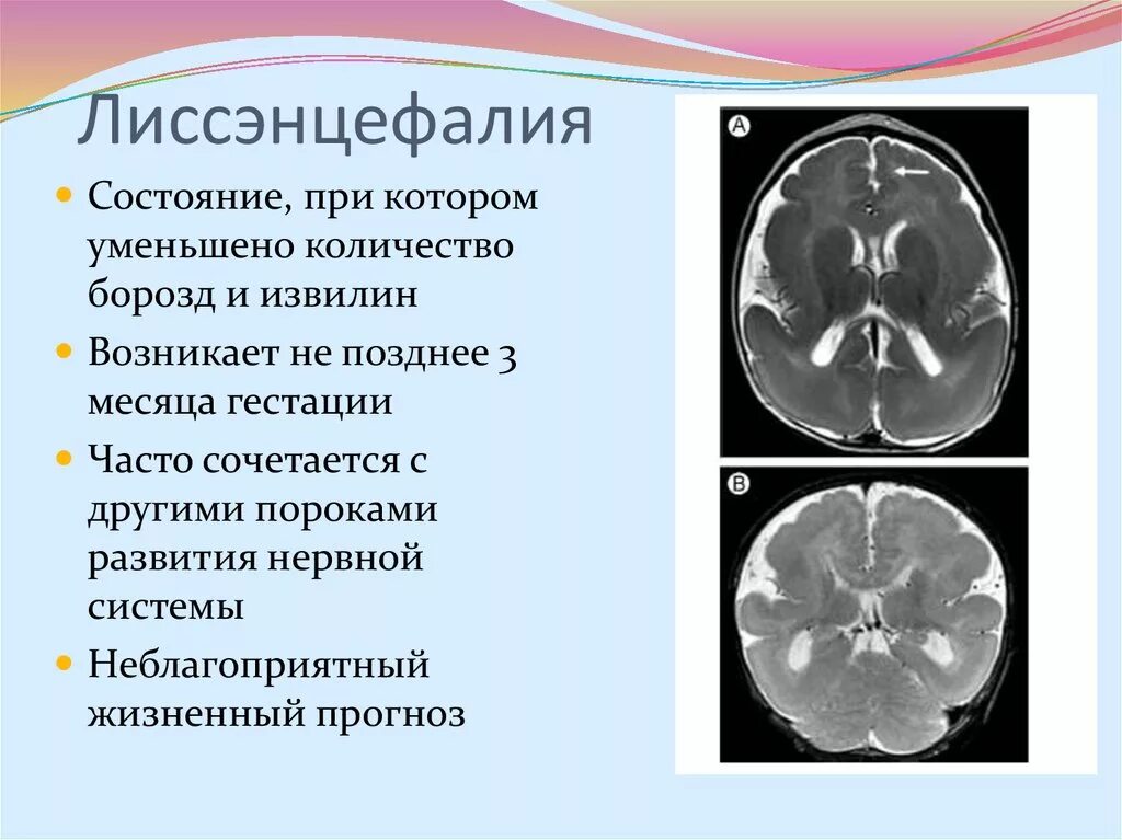 Миллера дикера. Лиссэнцефалия и синдром Миллера Дикера. Лиссэнцефалия-пахигирия. Лиссэнцефалия головного мозга у плода.