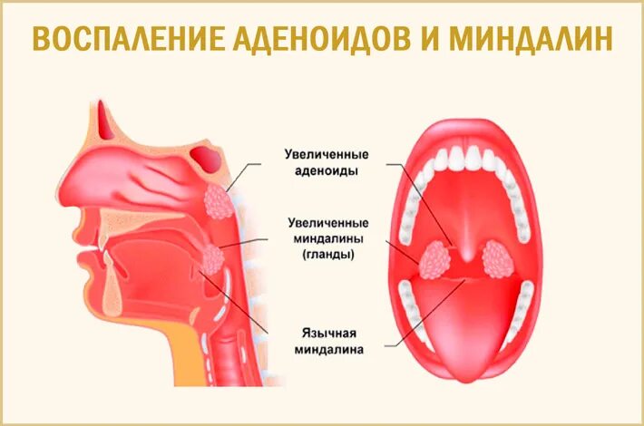 Миндалины и аденоиды болезни. Гланды аденоиды миндалины что это.