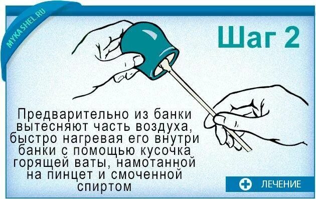 Как часто можно делать банки. Как ставить банки на спину при кашле сколько минут взрослому. Как правильно поставить банки на спину. Как ставить банки на спину при кашле. Как правильно поставить медицинские банки на спину при кашле.