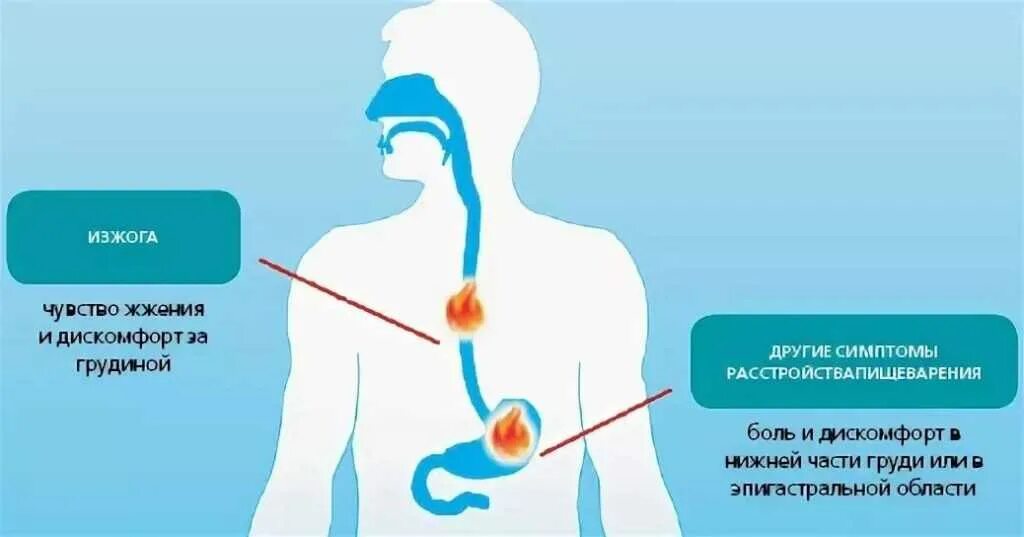 Болит пищевод причина. Симптомы изжоги желудка.