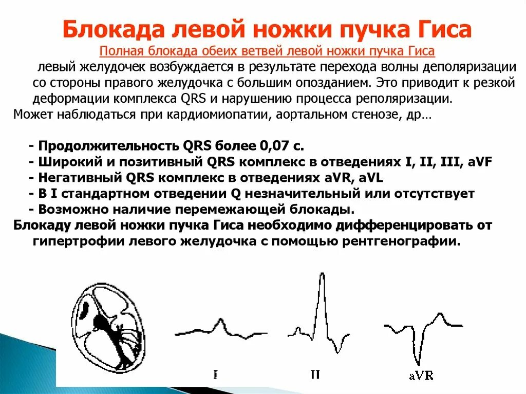 Блокада ЛНПГ причины. Полная блокада левой ножки пучка Гиса. Блокада левой ножки пучка Гиса причины. Причины блокады правой ножки пучка Гиса.