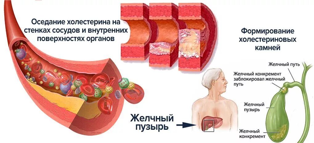 Желчь и холестерин