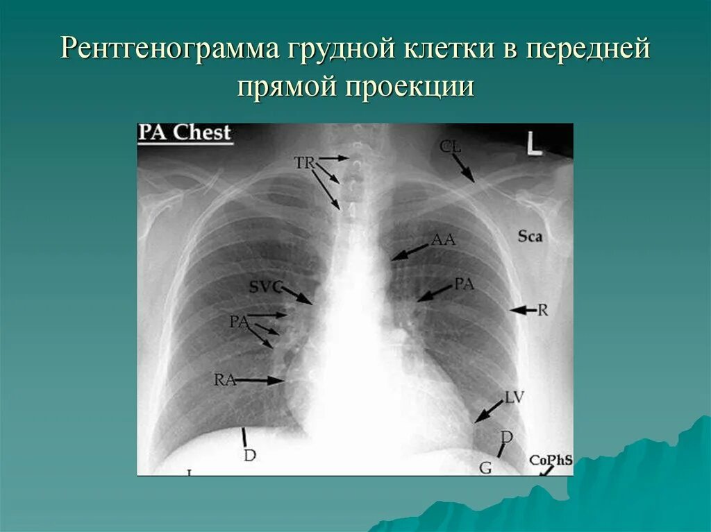 Рентген ОГК В боковой проекции норма. Рентген органов грудной клетки в прямой проекции. Рентгенограмма грудной клетки в прямой проекции. Легкие в прямой проекции