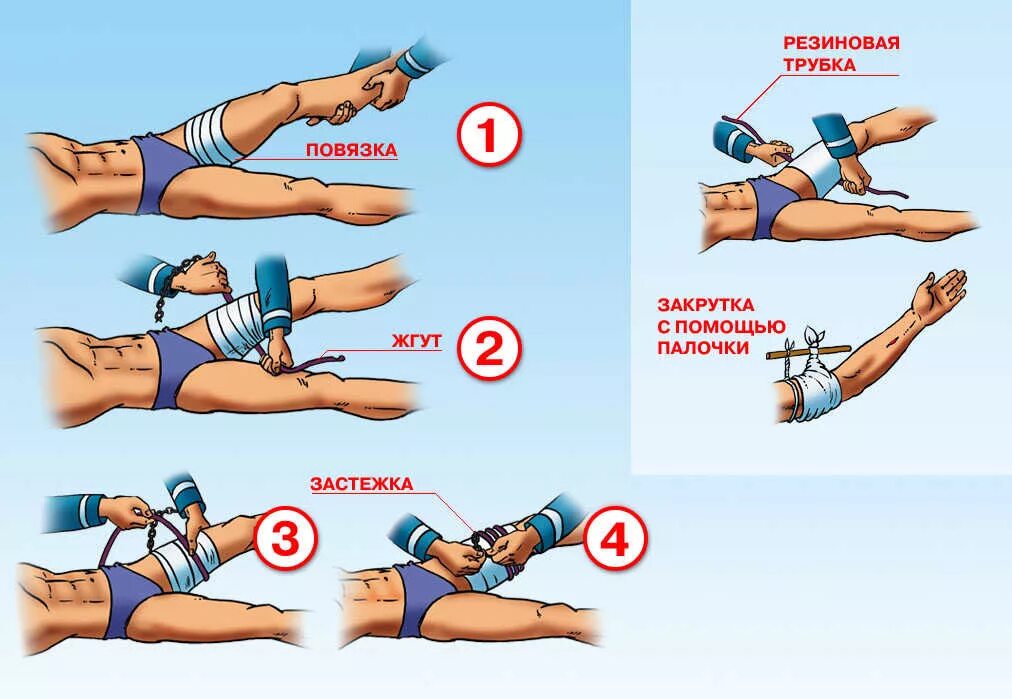 Наложение артериального кровоостанавливающего жгута. При правильном наложении жгута для остановки кровотечения:. Порядок накладывания жгута при артериальном кровотечении. Алгоритм накладывания жгута при кровотечении. Как правильно наложить артериальный жгут