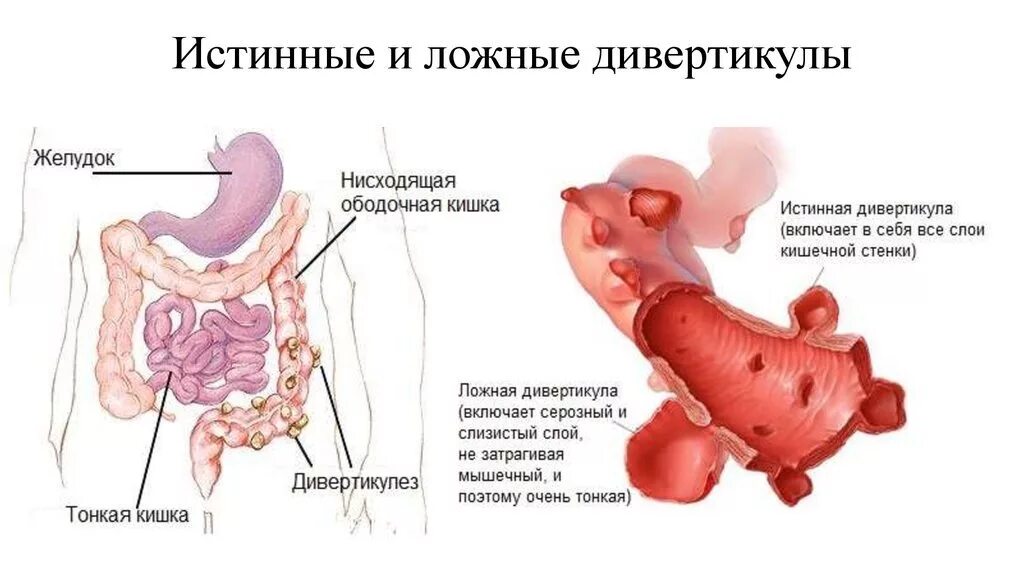 Резекция желудка анемия. Дивертикулит сигмовидной ободочной кишки. Дивертикулы толстой и сигмовидной кишки. Дивердигула сигмовилной кишки. Дивертикулёз кишечника сигмовидной кишки.