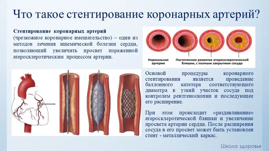 Расширяет коронарные сосуды. Стентирование сосудов артерии. Операция стентирование сосудов сердца. Стенты для коронарных сосудов. Ангиопластика и стентирование коронарных артерий.