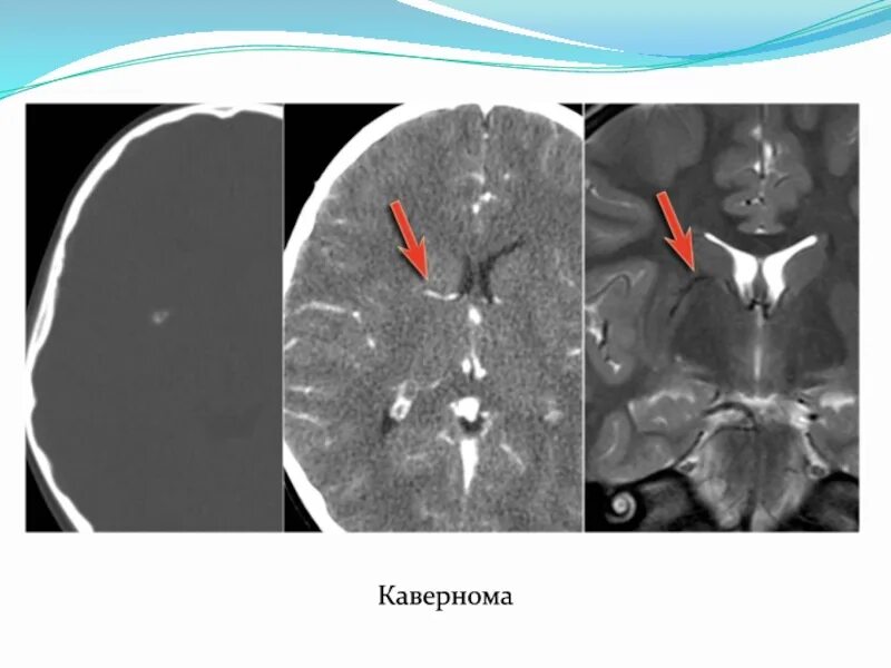 Кавернома мозжечка мрт. Ангиома правой лобной