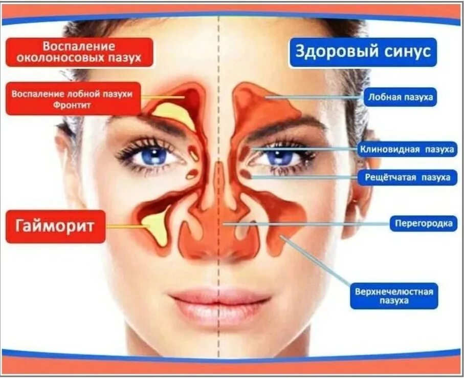 заболевания носа и придаточных пазух. гайморит фронтит этмоидит. ринит – воспалении слизистых оболочек носа. катаральный пансинусит. передается ли гайморит.