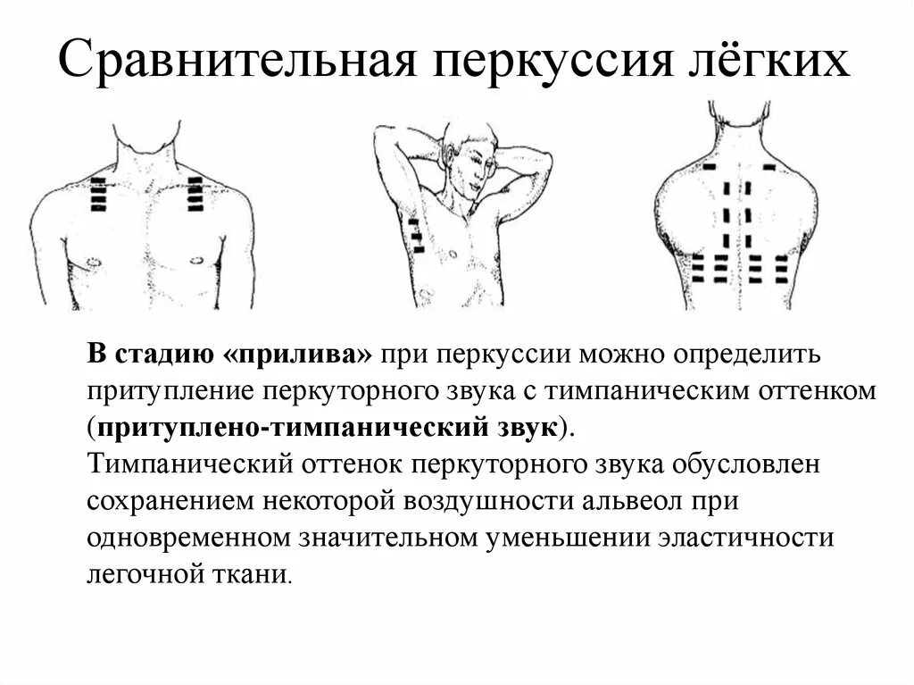 Топографические границы легких. Перкуссия грудной клетки пропедевтика. Перкуссия грудной клетки пропедевтика точки. Сравнительная перкуссия грудной клетки. Сравнительная перкуссия легких пропедевтика.