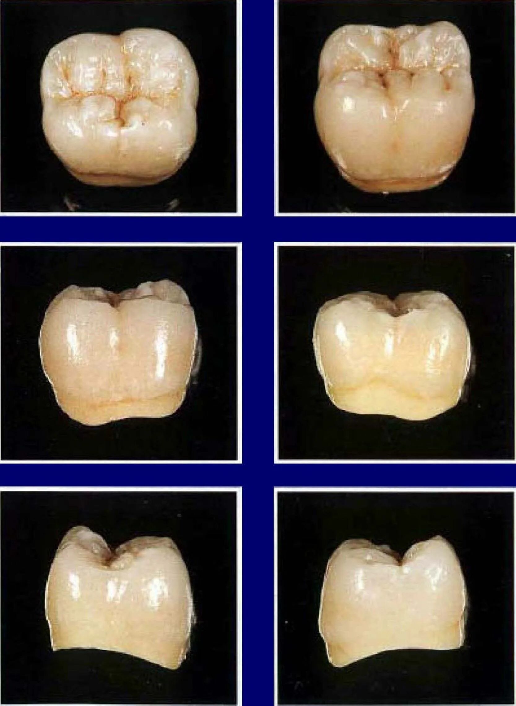 Tek kron Dental ceramics, Dental art, Dental laboratory