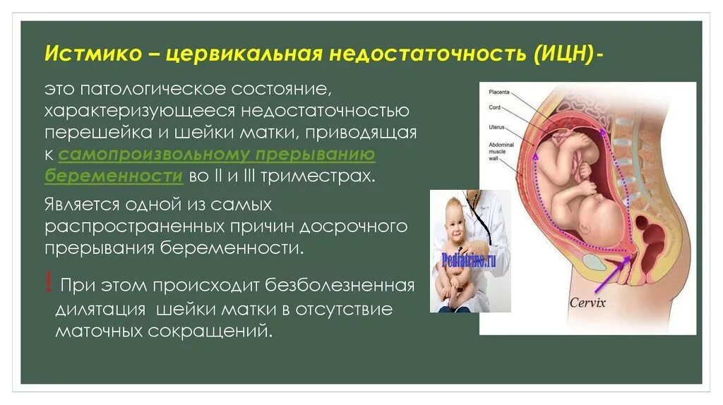 Покалывания внизу живота на ранних сроках беременности. Истмико-цервикальная недостаточность. Цервикальная недостаточность при беременности. ИЦН при беременности во втором триместре.