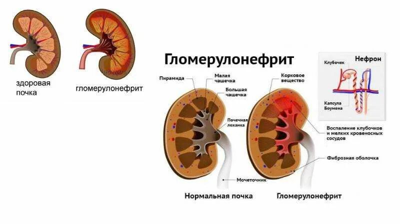 Гломерулонефрит эритроциты. Признаки гломерулонефрита почек. мочевыделительная система при хроническом гломерулонефрите. поражение клубочков гломерулонефрит.