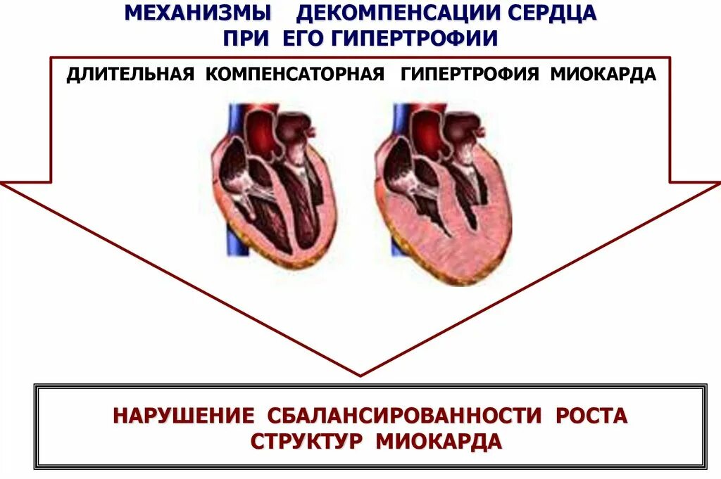 Сердечная декомпенсация это. Компенсаторная гипертрофия миокарда стадия декомпенсации. Компенсаторная гипертрофия сердца. Механизмы декомпенсации гипертрофии миокарда. Гипертрофия сердца декомпенсация это.