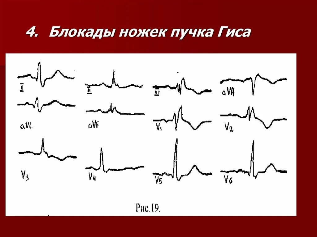 Частичная блокада ножки пучка гиса