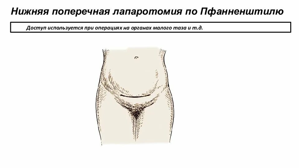 Нижняя поперечная лапаротомия по Пфанненштилю. Нижнесрединная лапаротомия. Поперечная лапаротомия по Пфанненштилю. Нижнесрединная лапаротомия разрез. Нижняя лапаротомия