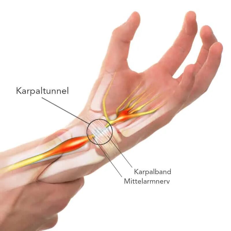 Туннельный синдром запястного канала. Синдром карпального клапана кисти. Туннельный синдром карпальный канал. Карпальный туннельный синдром кисти. Туннельный синдром после операции