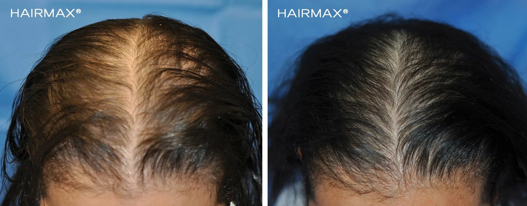 HAIRMAX LASERBAND 82. Выпадение волос до и после. Мезотерапия волос до и после. Выпадают волосы после операции