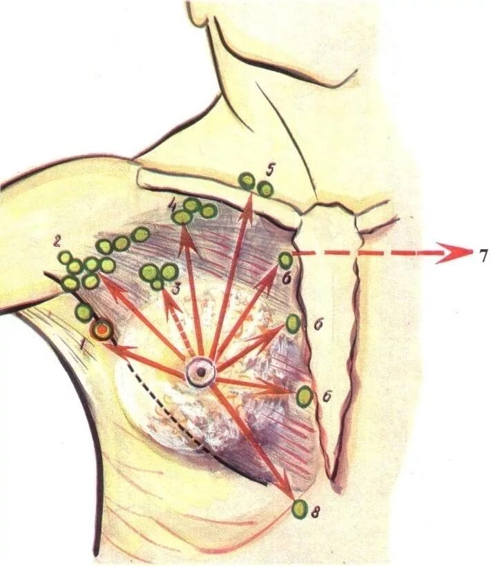 Лимфоузлы при рмж. Подключичные лимфоузлы. Подключичные лимфоузлы расположение схема. Сторожевой лимфатический узел молочной железы. Апикальные лимфоузлы молочной железы.