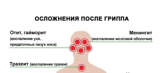 Последствия гриппа. Осложнения после гриппа. Осложнение на ухо после гриппа. Осложнение после гриппа на голову. Грипп осложнение на уши