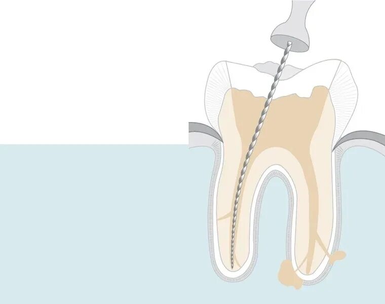 Root canal. Пульпита (депульпирование зуба. Депульпирование нерва зуба. Депульпирование зуба снимок. Депульпация корня зуба.