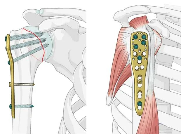 Остеосинтез при переломе шейки плечевой кости. Остеосинтез плеча пластиной. Остеосинтез плечевой кости пластиной. Костный остеосинтез плечевой кости. Перелом плеча пластина
