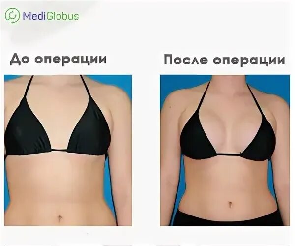 Увеличение груди фото до и после операции Viktorija Bekhema palikusi bez silikona krūtīm (FOTO) :: foto