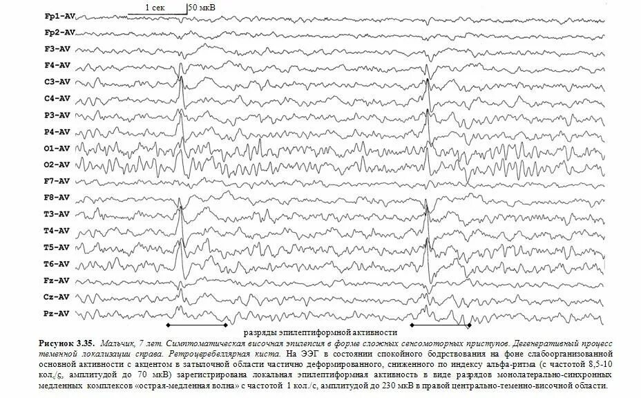 Эпилептиформные паттерны на ЭЭГ. Пароксизмальная активность на ЭЭГ. Острая-медленная волна на ЭЭГ. Пароксизмальная активность при ЭЭГ.
