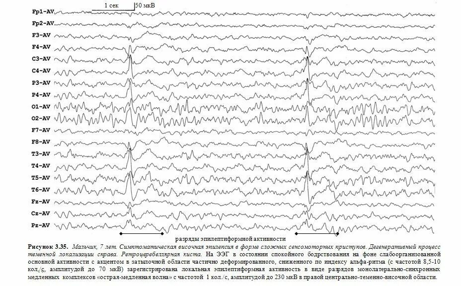 Эпилептиформные паттерны на ЭЭГ. Пароксизмальная активность на ЭЭГ. Острая-медленная волна на ЭЭГ. Пароксизмальная активность при ЭЭГ. Пароксизмальная активность мозга