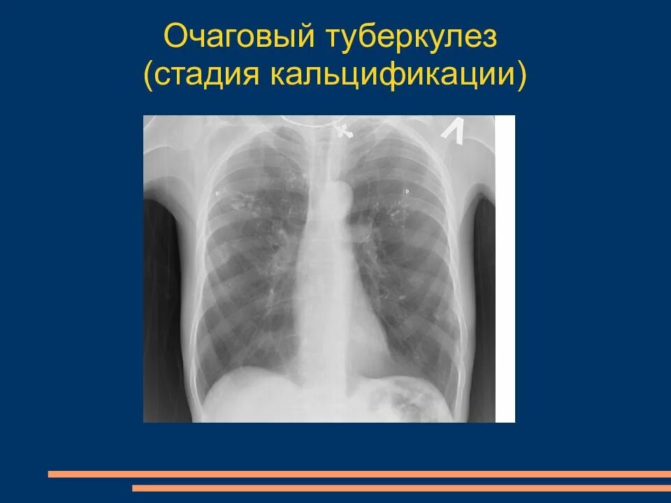 Очаговый туберкулез в фазе инфильтрации рентген. Очаговый туберкулез в фазе инфильтрации. Очаговый туберкулез фтизиатрия. Мягкоочаговый туберкулез легких рентген.