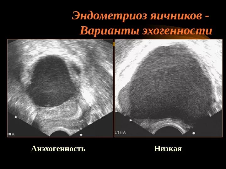 Эндометриоидная киста яичника. Эндометриоидная киста брюшины. Эндометриоз матки снимки УЗИ. Эндометриоидная киста на УЗИ.