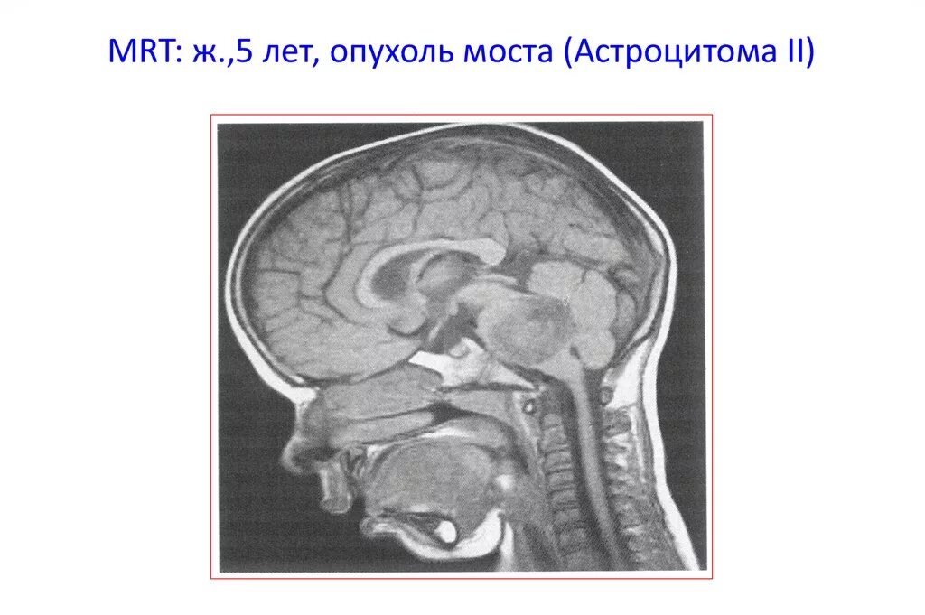 Глиома продолговатого мозга мрт. Глиома варолиева моста мрт. Глиома головного ствола