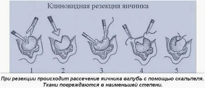 Гормоны после удаления яичника. Лапароскопическая клиновидная резекция яичников. Склерокистоз яичников операция. Поликистоз яичников хирургическое. Хирургическое лечение СПКЯ.