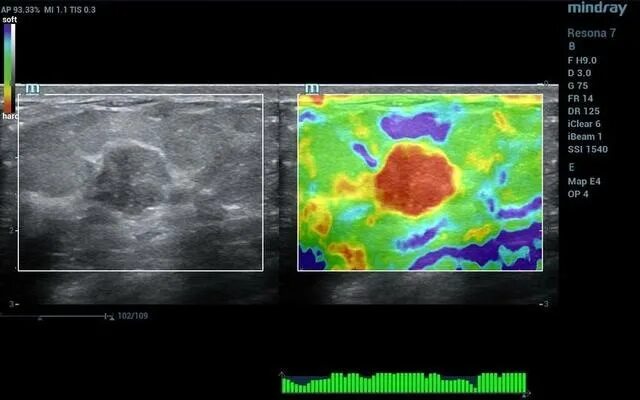 Ультразвуковая компрессионная эластография. УЗИ эластография печени. Эластография сдвиговой волны печени. Ультразвуковая эластография молочной железы.