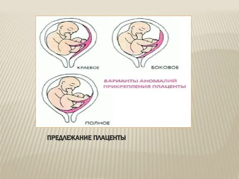 Плацента на какой неделе. Предлежание плаценты. Низкая плацентация краевое предлежание. Низкая плацента при беременности. Расположение плаценты при беременности.