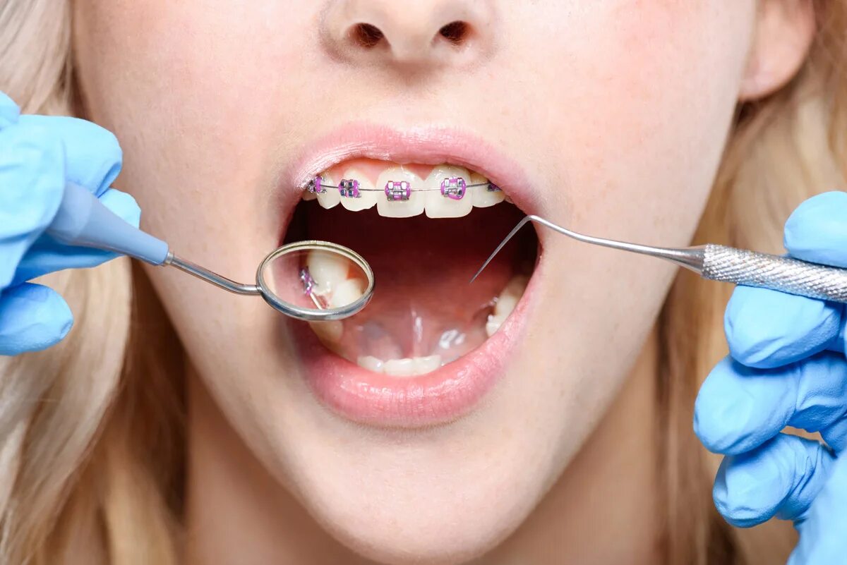 Ортодонтия что это. Саморегулирующиеся брекеты. Ортодонтия в стоматологии. Зуба стоматология брекеты.