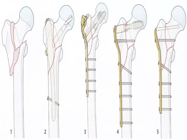 Перелом шейки бедренной кости реабилитация. Реабилитация при переломе бедренной кости. Этапы срастания перелома бедра. Перелом шейки бедра реабилитация этапы. Реабилитация после перелома бедренной кости после операции