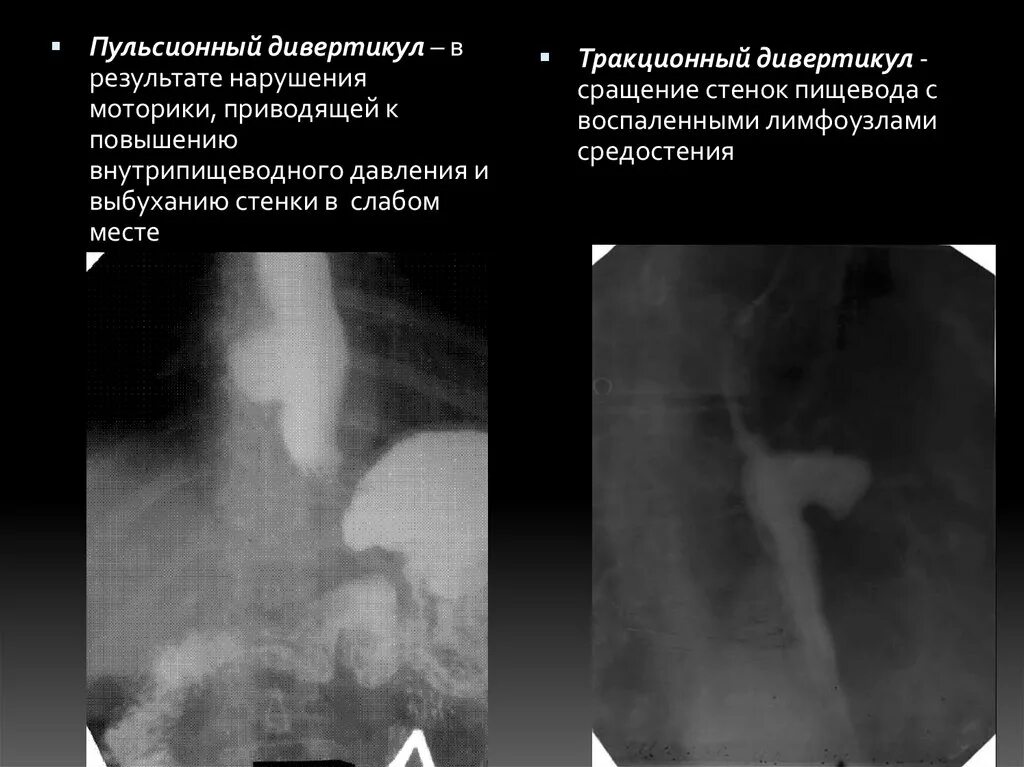 Пульсионный и тракционный дивертикул. Пульсионный дивертикул пищевода. Тракционный дивертикул. 2. Тракционный и пульсионный дивертикулы пищевода..