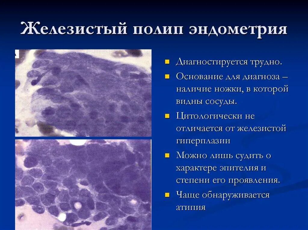 Кистозно расширенная железа. Железистый полип эндометрия гистология. Фиброзно железистый полип шейки матки микропрепарат. Фиброзно железистый полип эндометрия гистология. Гистология железисто-фиброзный полип.