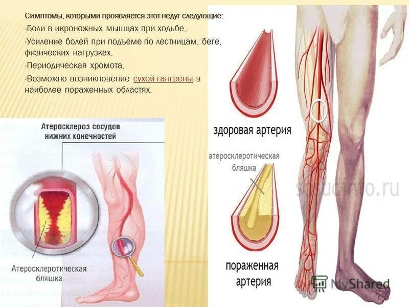 Ноющие боли внизу ног. Боль в икроножной мышце при ходьбе. Ноги боль икроножная мышца. Ноющие боли в икроножных мышцах.