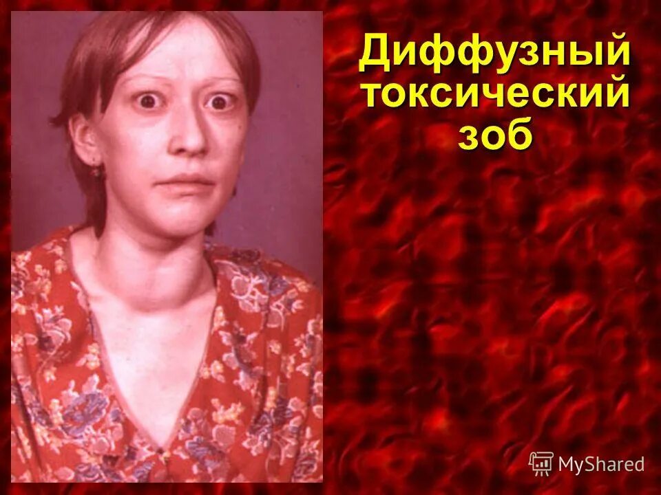 Эндемический зоб патофизиология. Диффузный эндемический зоб. Эндемический зоб эутиреоидный. Проявление эндемического зоба. Эндемический и токсический зоб.