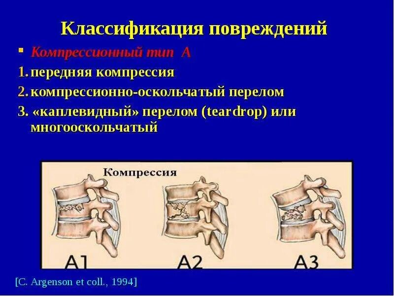 Повреждения позвоночника переломы. Классификация компрессионных переломов позвонков. Неосложненный компрессионный перелом. Типы компрессионных переломов тел позвонков. Компрессионный перелом позвоночника классификация.