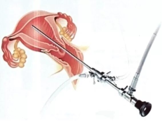Лапароскопия матки отзывы. Гистерорезектоскопия полипа. Гистерорезектоскопия полипа эндометрия. Гистероскопическое выскабливание эндометрия. Гиперплазия эндометрия гистероскопия.