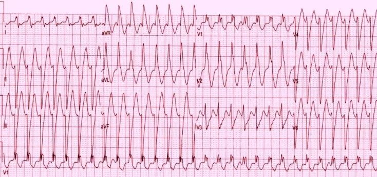 Широкий комплекс qrs. Наджелудочковая тахикардия с широкими комплексами на экг. пароксизмальная тахикардия с широким комплексом qrs на экг. тахикардия с широкими комплексами qrs на экг. широкий комплекс qrs на экг.
