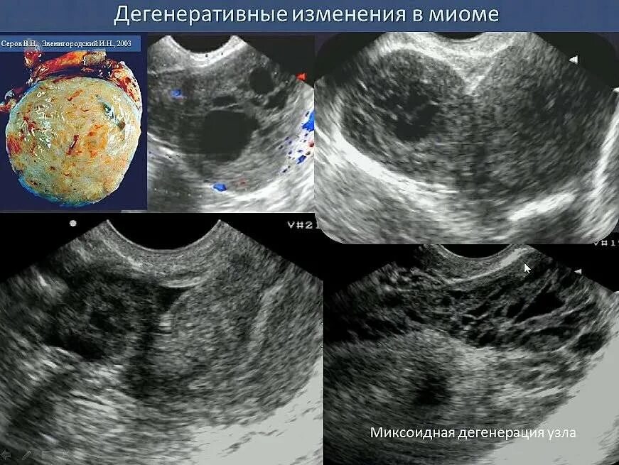 Шеечный миоматозный узел. Некроз миоматозного узла на УЗИ. Миома матки на ранних сроках