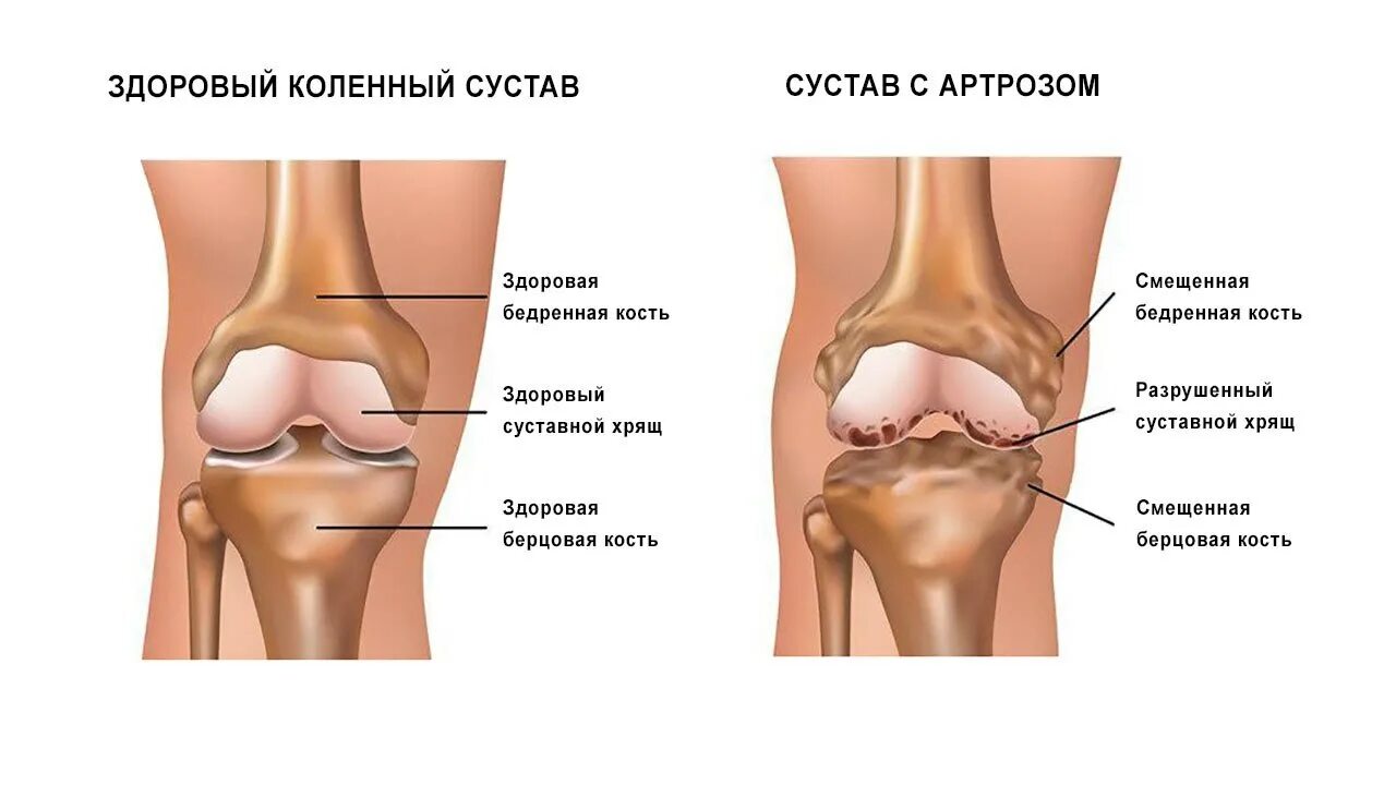 Боли коленного сустава симптомы. Суставной хрящ коленного сустава болит. Остеоартрит коленного сустава. Разрушение коленного сустава.