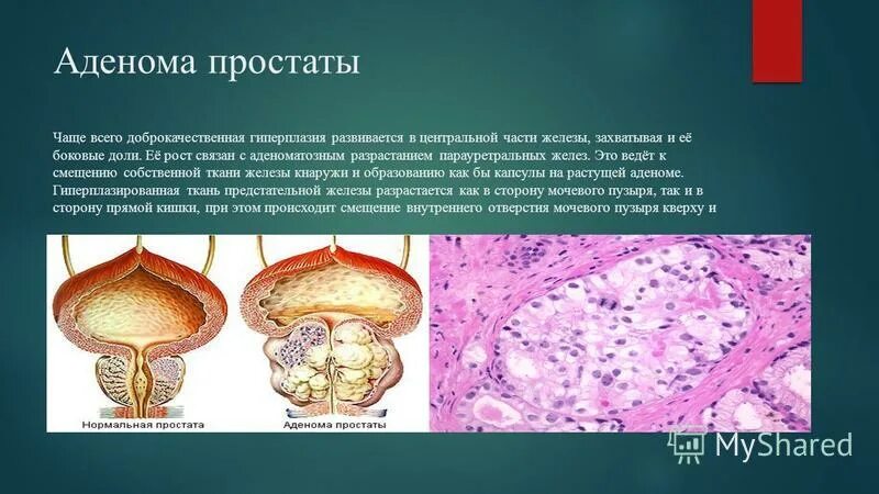 Простата развивается. Доли предстательной железы. Доброкачественная гиперплазия предстательной железы. Узелок предстательной железы.