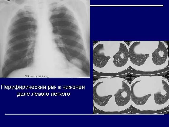 Очаговое образование левого легкого