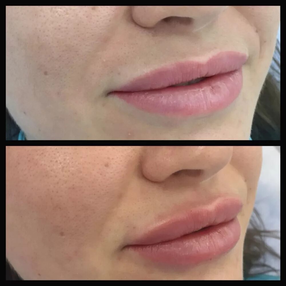 Липофилинга губ до после. Липофилинг губ до и после. Губы после липофилинга. Липофилинг губ собственным жиром. Липофилинг губ собственным жиром.